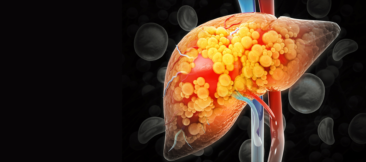 Fatty Liver To Liver Failure: Understanding The Progression & Prevention